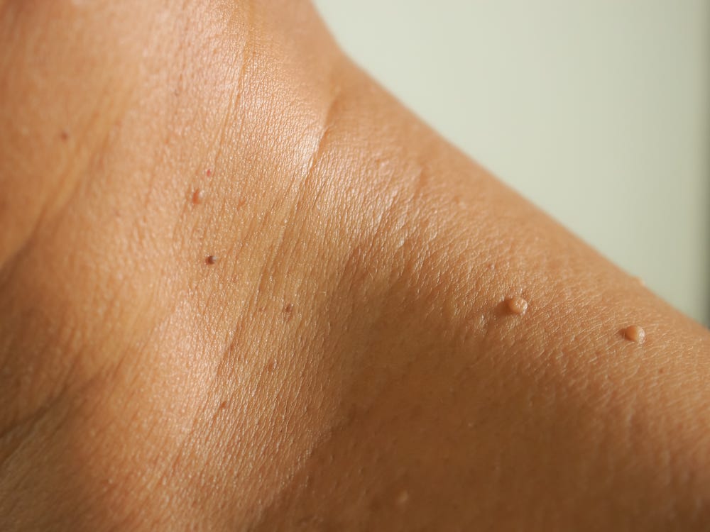 Skin Tag Removal: 8 Effective Home Remedies