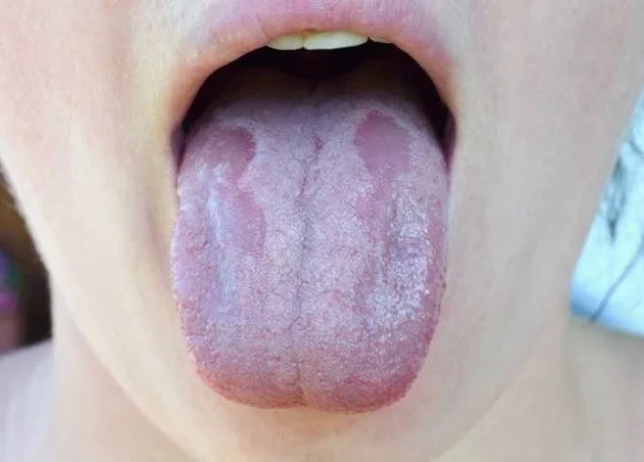 4 Candida overgrowth Symptoms, Causes and Treatment