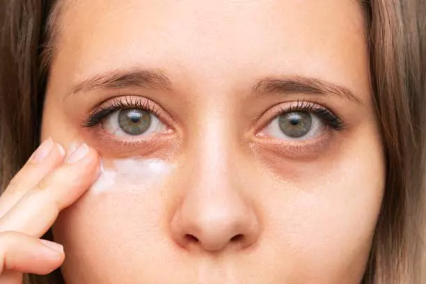 What causes dark circles under eyes? Do you want to know how to remove dark circles under eyes permanently? Okay, in this article you will learn how to get rid of dark circles under eyes as well as dark circles under eyes causes.