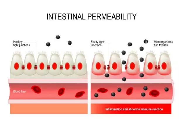 Intestinal Permeability - Symptoms, Causes and Treatment